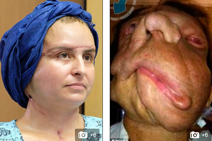 mujer trasplante de cara 