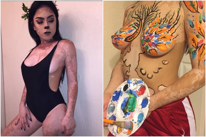 ¡OMG! Chica con vitíligo convirtió su cuerpo en una obra de arte