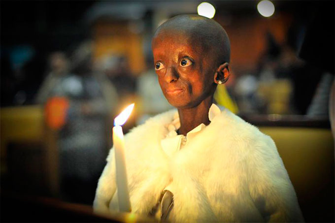 ¡Perdió la batalla! Falleció Ontlametse Phalatse al padecer progeria
