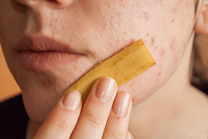 ¡Sorprendente! Elimina el acné con las cáscaras de cambur