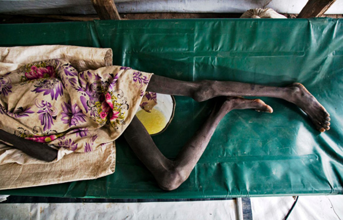 ¡Enfermedad sin control! 1.600 asiáticos han muerto por cólera en Yemen
