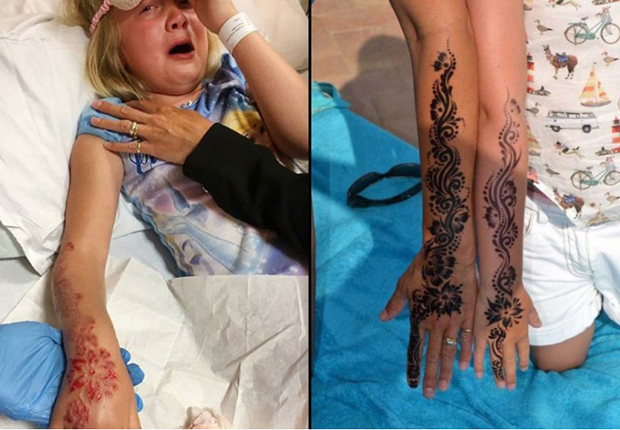 Peligroso! Tatuaje temporal causó daños a niña australiana (+fotos) - Actualidad