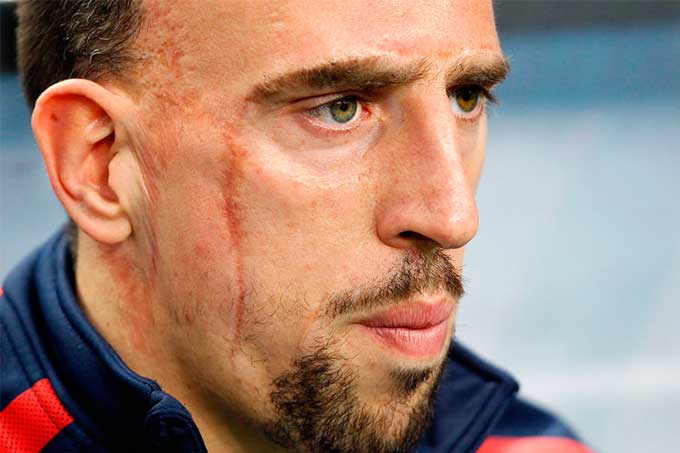 Franck Ribéry estará ausente del Bayern por lesión