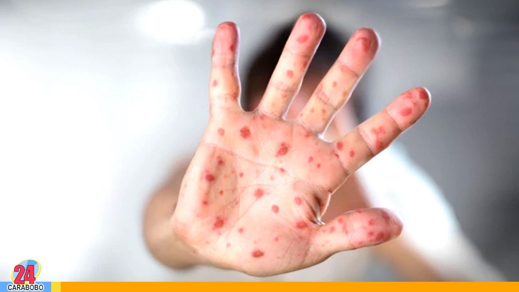 epidemia de sarampión-virus-enfermedad-noticias24carabobo