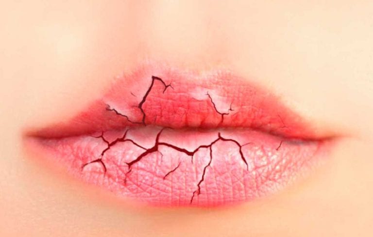 Cinco remedios caseros para tratar labios agrietados