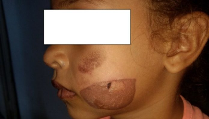 mujer quemó rostro de hija