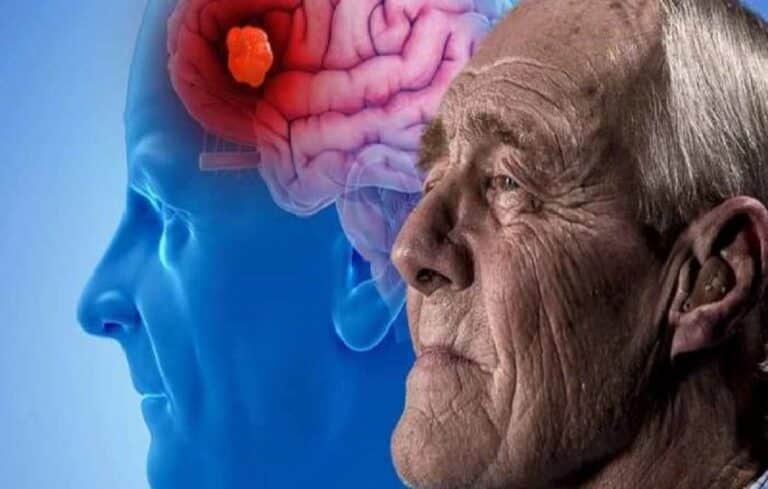 Fármacos para el TDAH servirían contra varios síntomas del Alzhéimer