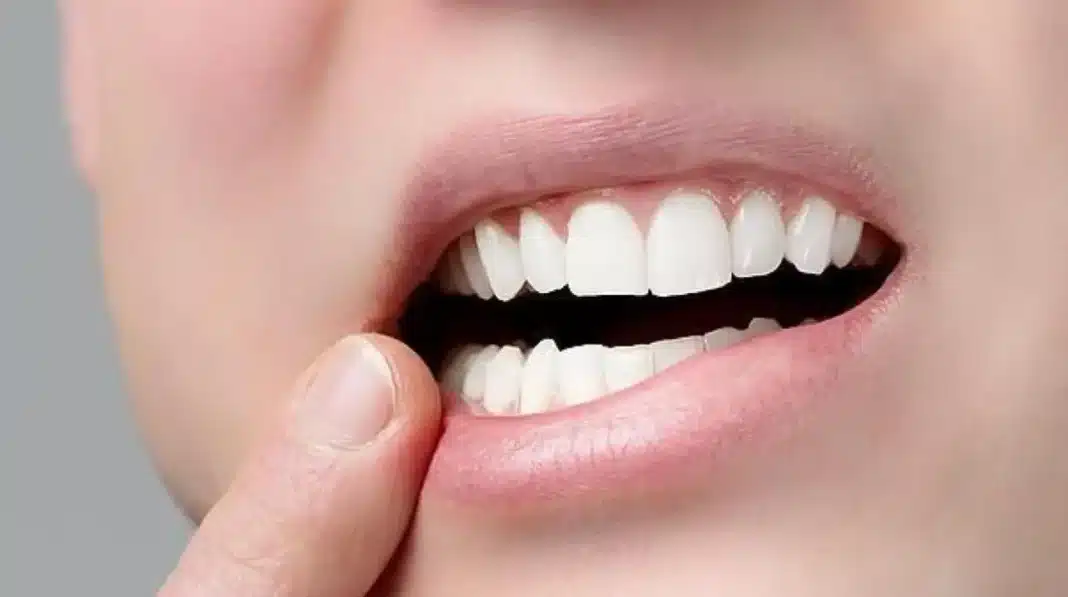 sarro dientes
