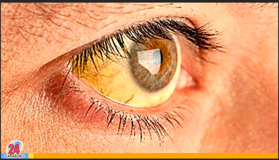 BLANCO DEL OJO ESTÁ AMARILLO