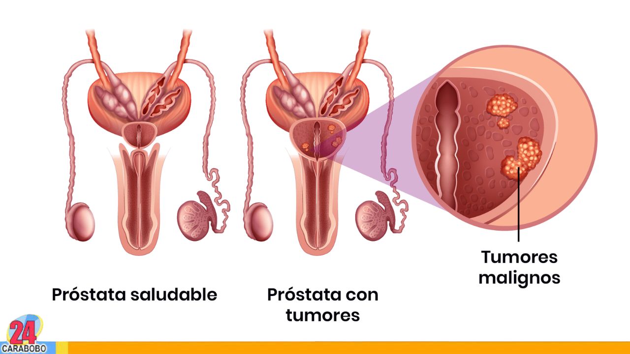 Conoce cinco afecciones que podrían confundirse con cáncer de próstata 3