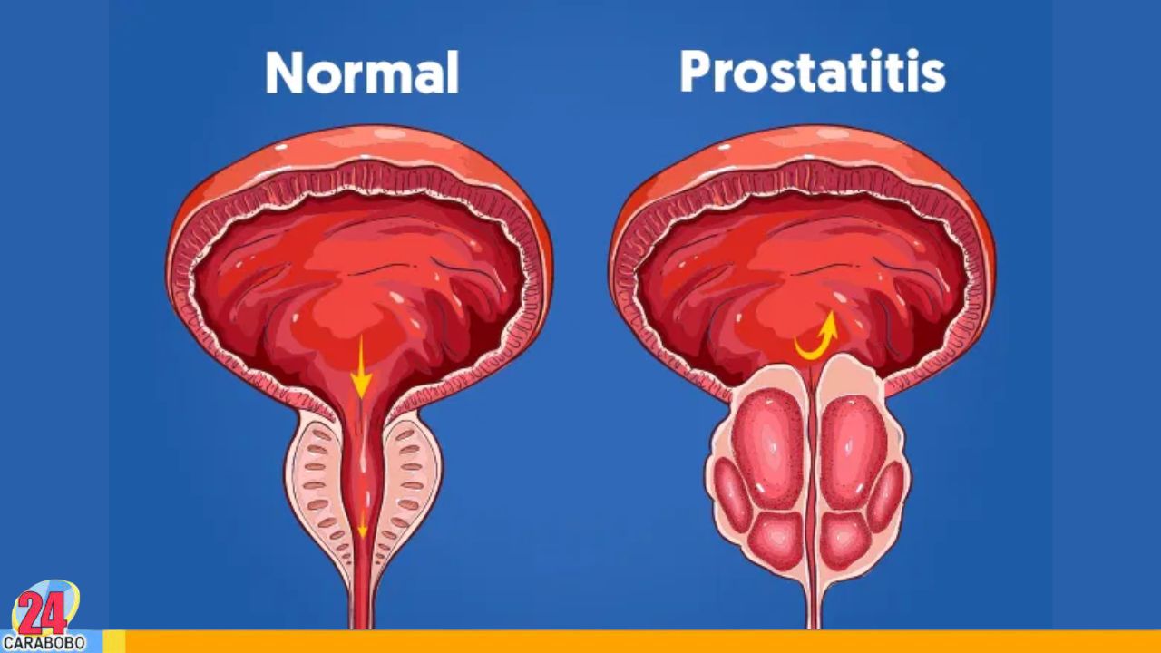 Conoce cinco afecciones que podrían confundirse con cáncer de próstata 5