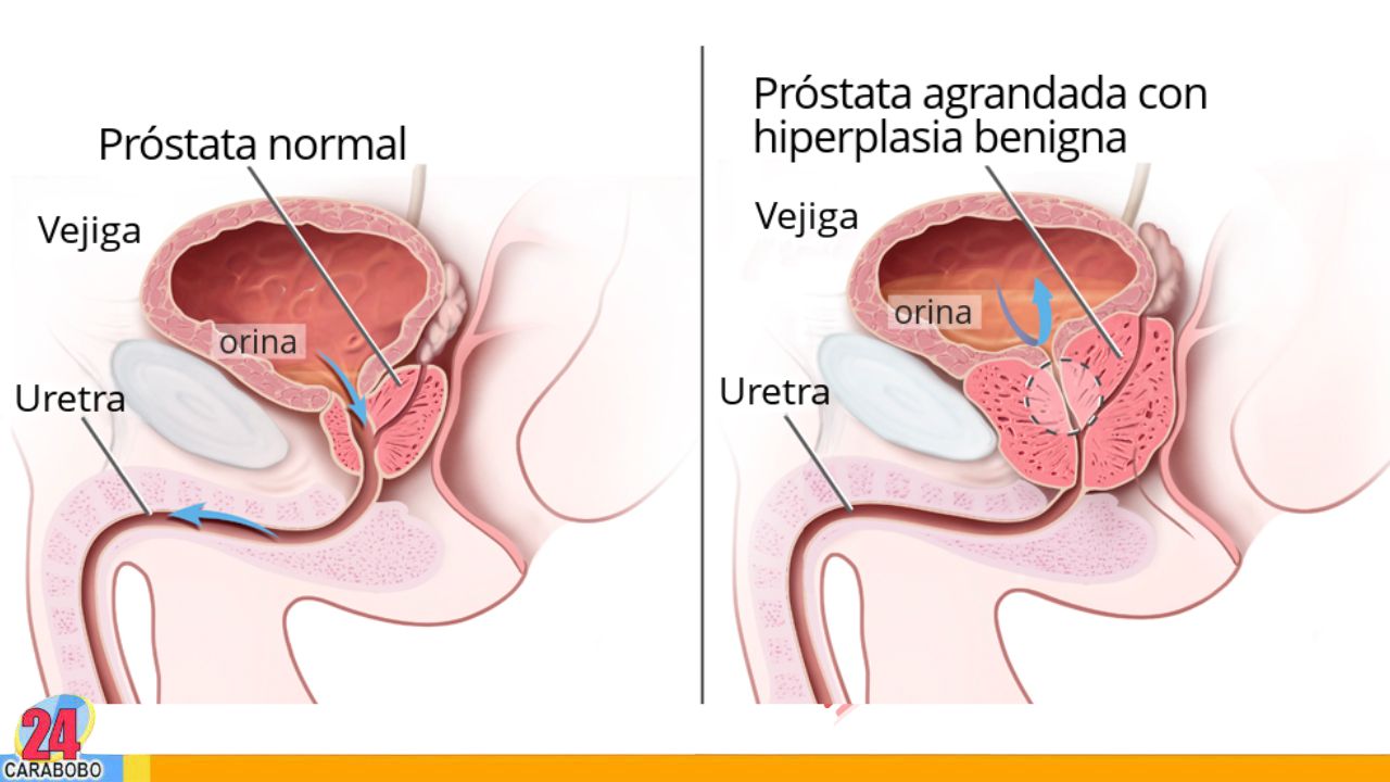 Conoce cinco afecciones que podrían confundirse con cáncer de próstata