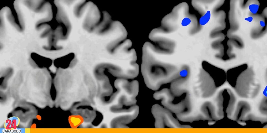 falta sueño cerebro a consumirse