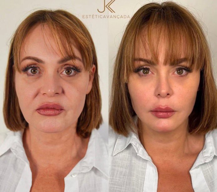 Gaby Spanic tras una cirugía en su rostro