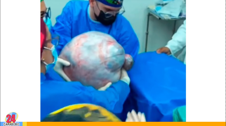 tumor de 25 kilos