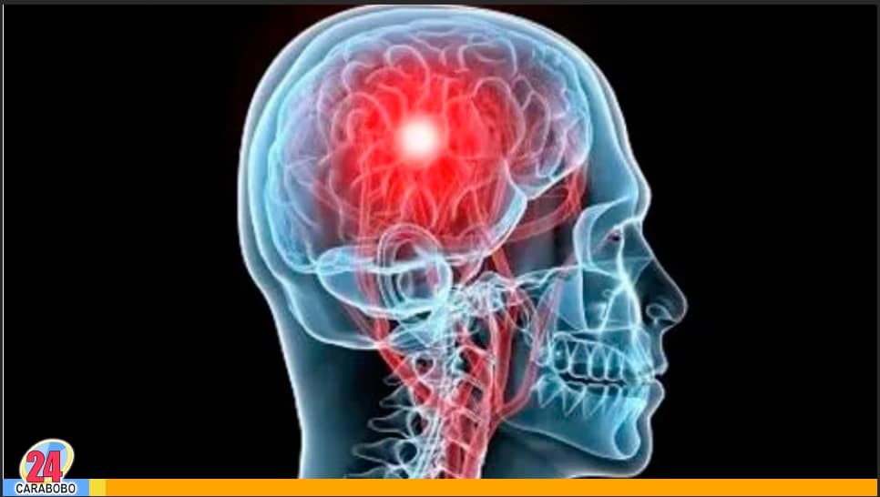Derrame cerebral